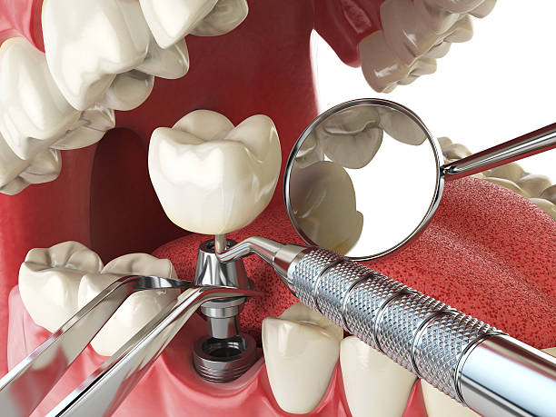 Best Emergency Dentist for Lost Fillings or Crowns in Yosemite Lakes, CA